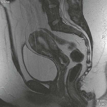 Magnetic resonance imaging of male and female genitals during。